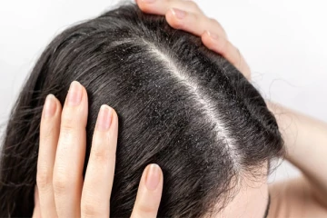 வந்த இடம் தெரியாமல் பொடுகை விரட்டியடிக்கும் வேம்பு, எலுமிச்சை: பயன்படுத்துவது எப்படி?