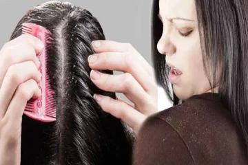 பொடுகு பிரச்சினையில் இருந்து தலைமுடியைக் காப்பாற்ற அருமையான சித்த மருத்துவ முறை!