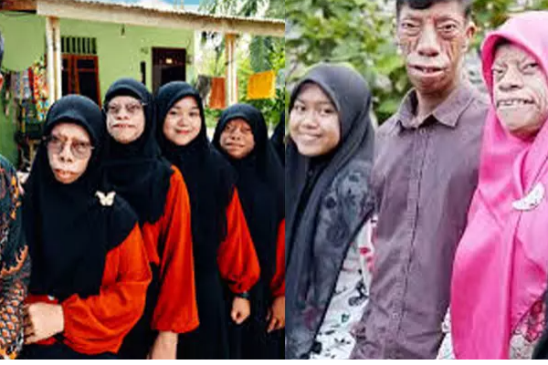 அரிய வகை நோயால் பாதிக்கப்பட்ட குடும்பம் உலக அளவில் பிரபலம் | Indonesia Family Worldwide Recognition Disease
