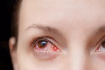 Madras Eye வந்தால் மூளையில் பாதிப்பு ஏற்படுமா? மருத்துவரின் விளக்கம்