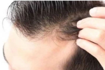 முன் நெற்றியில் விழும் வழுக்கை போக்க வேண்டுமா? வாரம் இரண்டு நாட்கள் இந்த மூன்று எண்ணெய்யை தேயுங்கள்!