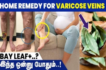 வெரிகோஸ் வெயின் அறிகுறிகள் என்ன? சரிசெய்ய எழிய வழிமுறைகள்