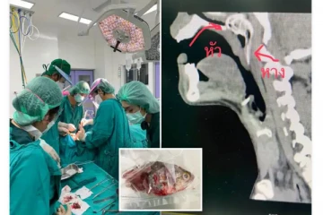 மீனவரின் வாய்க்குள் நுழைந்து தொண்டையில் சிக்கிய மீன் - விநோத சம்பவம்!