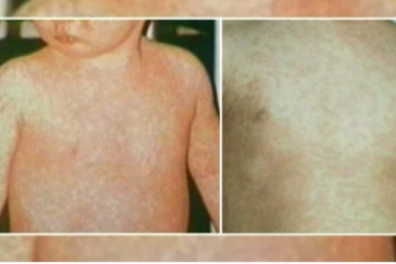 தட்டம்மை நோய்க்கு எதிராக மேலதிக தடுப்பூசி ஏற்றும் நடவடிக்கை