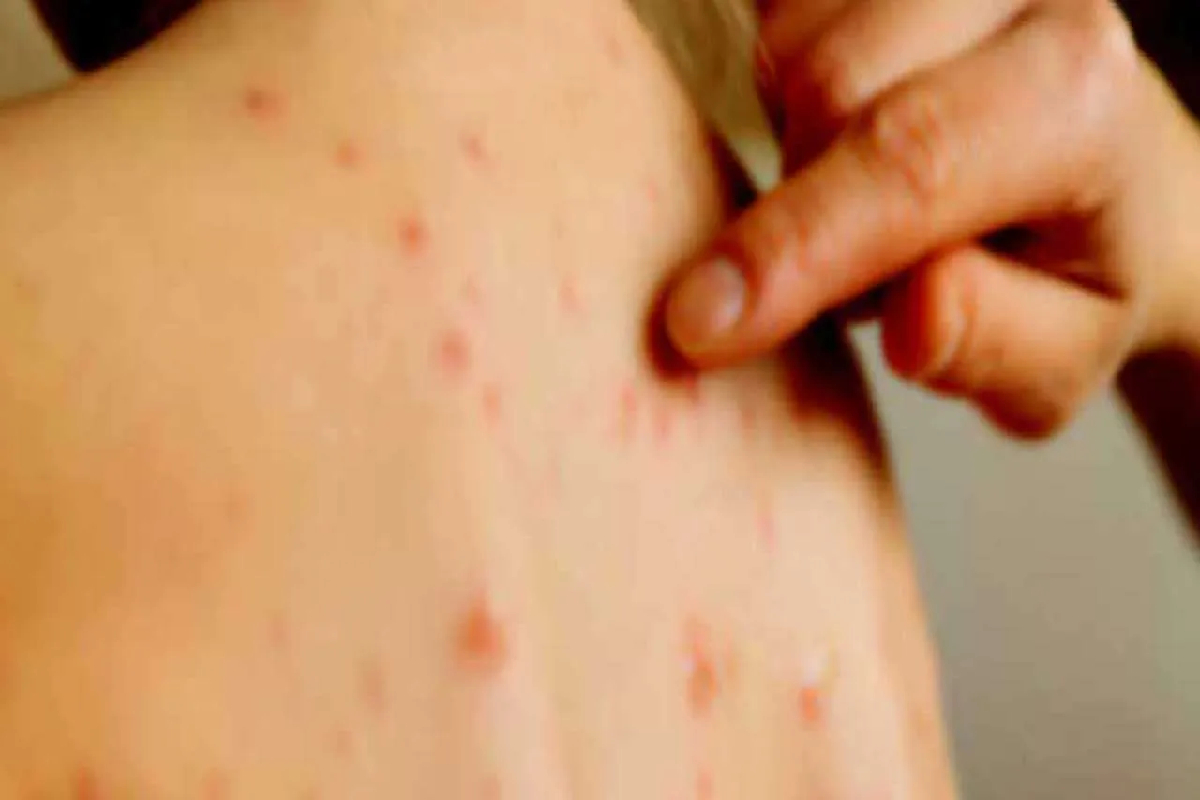 இலங்கையில் மீண்டும் தட்டம்மை நோய் : மரணத்திற்கு வழிவகுக்கும் என எச்சரிக்கை | Two Measles Patients Found In Colombo