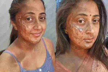 முகத்தில் ஏற்பட்ட தீ காயம், போட்டோ வெளியிட்டு ரசிகர்களுக்கு ஷாக் கொடுத்த சீரியல் நடிகை... என்ன ஆச்சு?