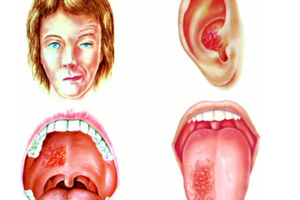 ஜஸ்டின் பீபருக்கு வந்த நோய்! முகத்தின் ஒரு பக்கம் அசையவில்லை | Ramsay Hunt Syndrome In Tamil