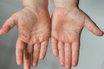 கேரளாவில் பரவும் தக்காளி காய்ச்சல்! ஆபத்து ஏற்படுமா?