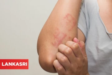 அரிக்கும் தோலுக்கு இதோ சில 6 அற்புதமான வீட்டு வைத்தியங்கள்!