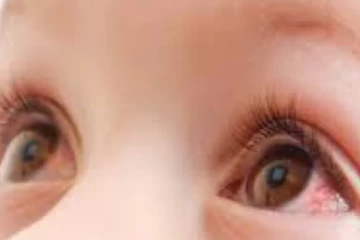 කුඩා ළමුන් අතර පැතිර යන ඇස් රෝගයක් - දෙමාපියන්ගෙන් ඉල්ලීමක්.