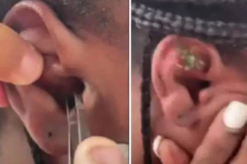 இளம்பெண்ணின் காதிலிருந்து எடுக்கப்பட்ட நண்டு