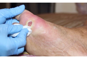 சர்க்கரை நோயாளிகளே காலில் புண் வந்தால் என்ன செய்ய வேண்டும் தெரியுமா? ஜாக்கிரதை...!