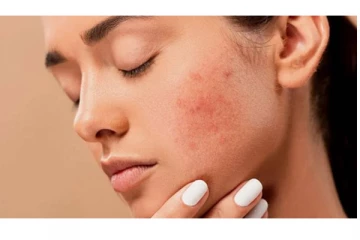 முகத்தில் உள்ள வடுக்கள் சரியாக வேண்டுமா? இதோ இருக்கே வீட்டு வைத்தியம்