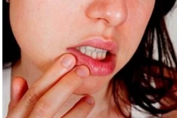 உங்களுக்கு அடிக்கடி வாய் புண் ஏற்படுகிறதா? இது தான் காரணம்.. கட்டாயம் தெரிந்து கொள்ளுங்கள்