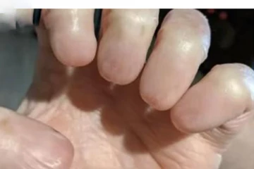 நகங்கள் இல்லாத விரல்கள் - அதிரவைக்கும் புகைப்படம்!