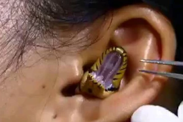 இளம் பெண்ணின் காதுக்குள் இருந்து எட்டி பார்த்த பாம்பு! பேரதிர்ச்சியில் உறைந்த மருத்துவர்கள்