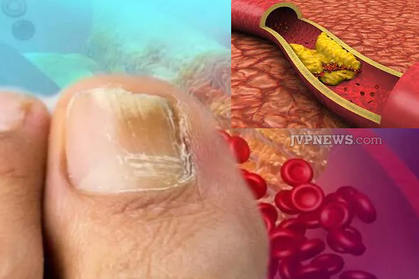 உங்க நகங்கள் இப்படி இருக்கா? அலட்சியம்வேண்டாம்; காத்திருக்கும் அபாயம் | If Cholesterol Levels Changes In The Nails