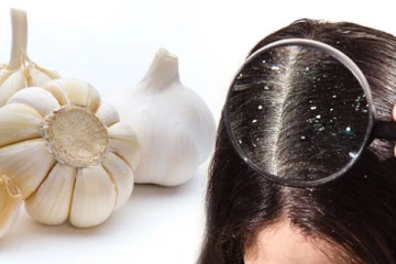 மோசமான பொடுகை நிரந்தரமா விரட்டும் பூண்டு! இப்படி பயன்படுத்தி பாருங்க