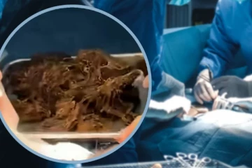 15 வயது சிறுமியின் வயிற்றிலிருந்த 2 கிலோ தலை முடி