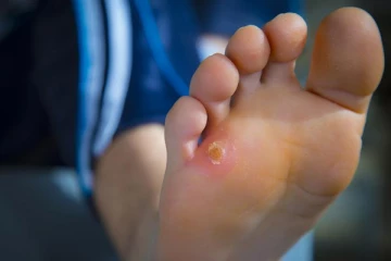 கால் பாதங்களில் ஆணியா? ஒரு தடவை தடவினால் போதும் வேரோடு எடுத்து விடும் சூப்பரான டிப்ஸ்