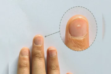 கை விரல்களில் இந்த அடையாளங்கள் இருக்கா? உடலில் இந்த நோய் இருப்பது உறுதி