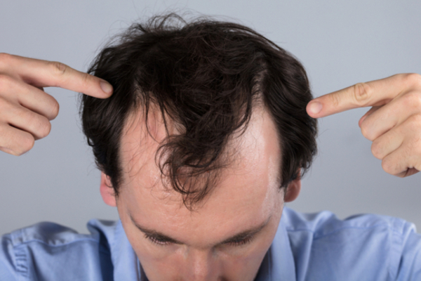 நீரிழிவு நோயாளிகளுக்கு முடி உதிர்வு நாளுக்கு நாள் அதிகரிக்கும்...ஏன் தெரியுமா? தவிர்ப்பது எப்படி? | Diabetes Hair Loss