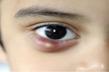 கண்கட்டியை குணமாக்க எளிமையான வீட்டு வைத்தியம்! உடனே ட்ரை பண்ணி பாருங்க.. உடனடி தீர்வு