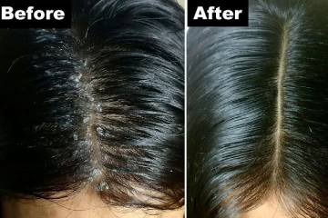 பொடுகுத் தொல்லையா? இதை மட்டும் செய்ங்க... 1 வாரத்தில் தீர்வு