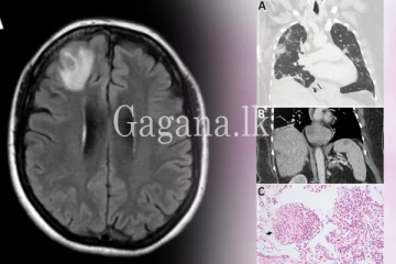 කාන්තාවකගේ මොළයෙන් හමු වූ වට පණුවා. (VIDEO)