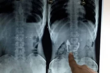 திருடிய நகையை விழுங்கிய கொள்ளையன் வைத்தியசாலையில் அனுமதி