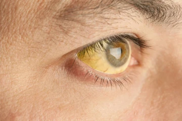 உயிரை மறைமுகமாக எடுக்கும் மஞ்சள் காமாலை!   இதோ சில ஆயுர்வேத தீர்வுகள்