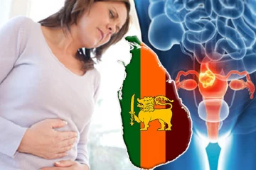 இலங்கையில் அதிகரிக்கும் கர்ப்பப்பை வாய்ப் புற்றுநோய் : செய்திகளின் தொகுப்பு