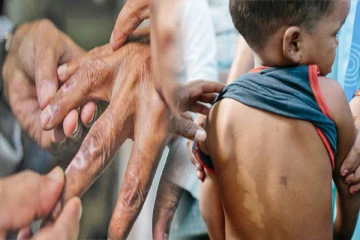 சிறுவர்களிடையே பரவும் தொழுநோய் ; வைத்திய நிபுணர் எச்சரிக்கை