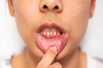 அடிக்கடி வாயில் புண் வந்தால்.. அது புற்றுநோயின் அறிகுறியா?