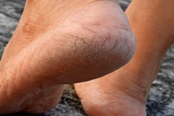 பாத வெடிப்பை மறைய செய்யும் டிப்ஸ்- இலகுவாக செய்யலாம்