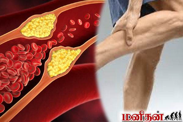 அடிக்கடி கால் வலி, தசை பிடிப்பு ஏற்படுகின்றதா? இந்த உணவை நிறுத்திக்கோங்க | Heavy Leg Pain Reason High Cholestrol அடிக்கடி கால் வலி, தசை பிடிப்பு ஏற்படுகின்றதா? இந்த உணவை நிறுத்திக்கோங்க | Heavy Leg Pain Reason High Cholestrol