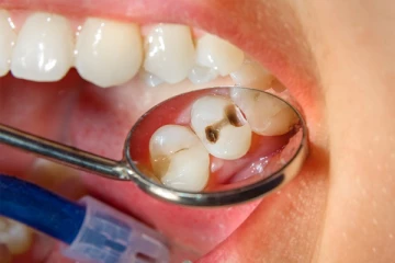 பல் பிரச்சனைகளுக்கு நல்ல தீர்வு தரும் இயற்கை மருத்துவ குறிப்புகள் இதோ !!