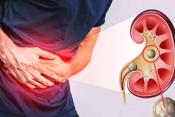 சிறுநீரக கற்களைக் கரைக்க உதவும் எளிய வழிமுறைகள்! | Simple Steps Dissolve Kidney Stones Health Tips சிறுநீரக கற்களைக் கரைக்க உதவும் எளிய வழிமுறைகள்! | Simple Steps Dissolve Kidney Stones Health Tips