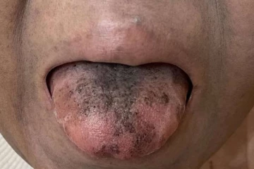 நாக்கில் கருப்பு ரோமம்... அரிதான பாதிப்பால் அவதிக்குள்ளான பெண்: விரிவான பின்னணி