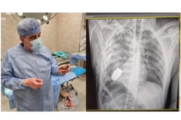 ராணுவ வீரர் உடலிலிருந்து எந்த நேரத்திலும் வெடிக்கக்கூடிய கையெறி குண்டுகளை அகற்றிய மருத்துவர்...!