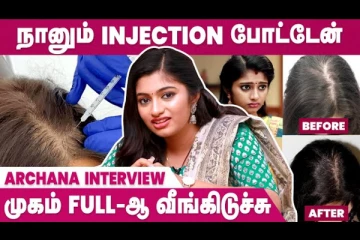முடி வளரத்துக்கு ஊசி போட்டேன் - ராஜா ராணி 2 சீரியல் நடிகை அர்ச்சனா