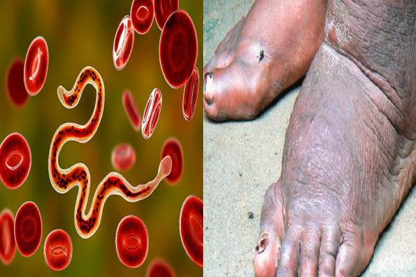elephantiasis symptoms: யானைக்கால் நோய்... தொற்று நோயா? அறிகுறிகள் எப்படியிருக்கும்? | Elephantiasis Symptoms In Tamil