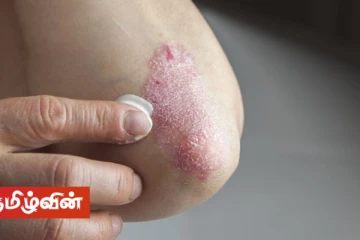 அனுராதபுரத்தில் வேகமாக பரவும் பூஞ்சை தொற்று - அவதானமாக இருக்குமாறு எச்சரிக்கை