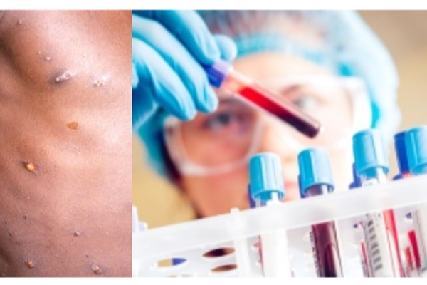 இனி குரங்கு அம்மை இல்லை.. எம் பாக்ஸ் - WHO திடீர் அறிவிப்பு! | Mbox As A New Name For Monkeypox Who