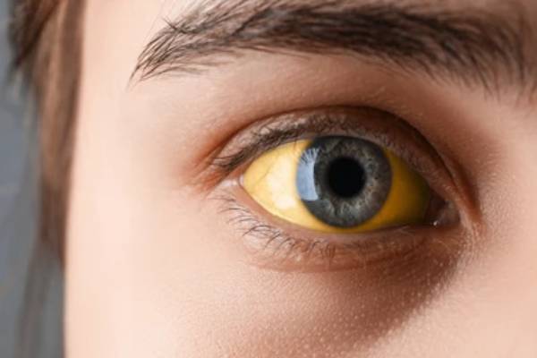 ஆப்பிள் சாப்பிட்டால் மஞ்சள் காமாலை வராதா? வீரியத்தை குறைக்க ஒரு டிப்ஸ் | Jaundice Is Not A Seasonal Disease Daily Habits