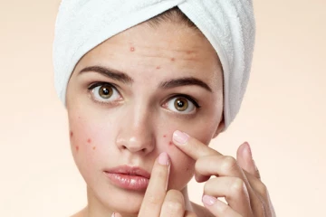 Pimples නැති කරන Simple Treatment 6ක්.