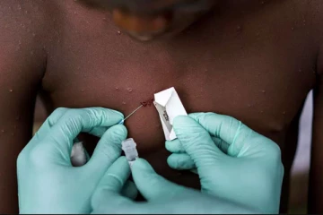 භයානක මන්කිපොක්ස් ලංකාවටත් ඇවිත් ද..? භයානක අනතුරි ඇගවීමක්..