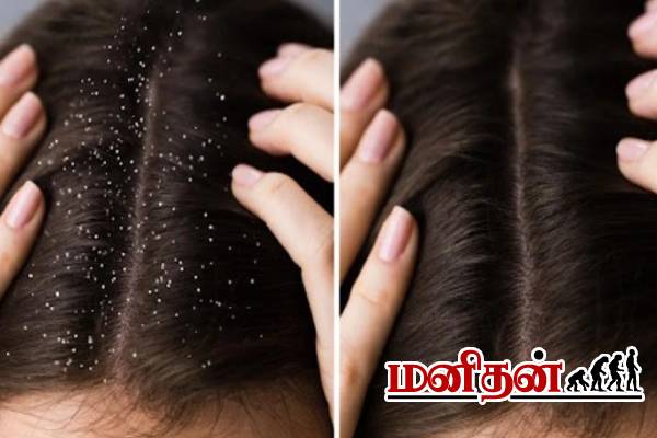 இந்த பேக் போடுங்க.. பொடுகு தொல்லை தீரும்! | Hair Care Tips Dandruff Hair Masks