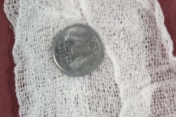 2 வயது சிறுவனின் தொண்டையில் சிக்கிய நாணயம்: மருத்துவர்களின் தரமான செயல்