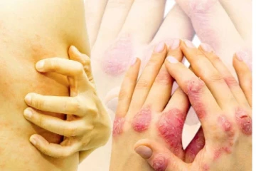 දිස්ත්රික්ක 03කින් බයානක රෝගයක් හමුවෙයි..එම දිස්ත්රික්ක මෙන්න..දැඩි අවධානයෙන් සිටින්න
